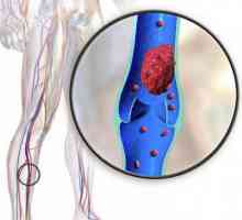 Prevenirea trombozei vasculare: sfaturi de la specialiști