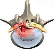 Protruziile coloanei vertebrale lombosacrale. Tratamentul proeminențelor regiunii lombare