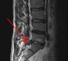 Protruzia coloanei vertebrale lombare. Cum se trateaza proiectia discurilor spinarii?