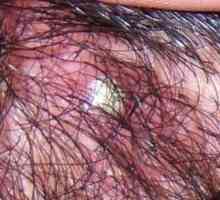 Acnee pe capul de sub păr: cauzele apariției și caracteristicile tratamentului