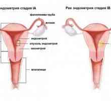 Cancerul endometrial al uterului: simptome, semne, etape, diagnostic și tratament