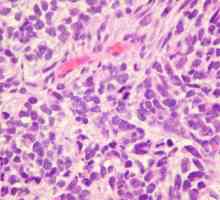 Cancer pulmonar cu celule mici: diagnostic, tratament, prognostic