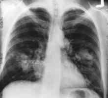 Cancerul pulmonar: câți trăiesc? Trebuie să cred previziunile?