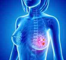 Breast Cancer: Simptome și Semne, Etapele bolii
