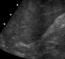 Dimensiunile ficatului sunt normale în ultrasunete (decodare)