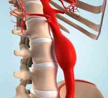 Ruptura aortei: cauze, prim ajutor, consecințe