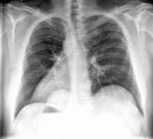 Radiografia este o metodă de studiu a structurii interne a obiectelor care utilizează raze X.…