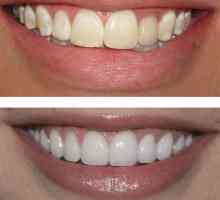 Restaurarea dinților: înainte și după. Restaurarea artei dintilor