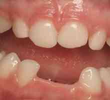 Retenția este ceea ce este în stomatologie?