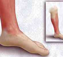Gura pe jos (inflamația piciorului erizipelat). Tratament: remedii populare. Erysipelas: simptome…