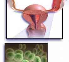 Salpingoophorita este o inflamație a ovarelor