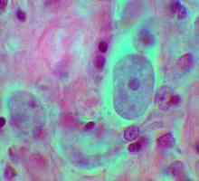 Cele mai frecvente infecții sunt protozoale