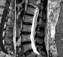 Sarcomul coloanei vertebrale: diagnostic și tratament