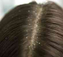 Seborrhea scalpului: cauze, simptome și tratament