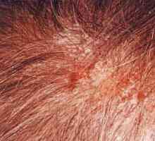 Dermatita seboreică la nivelul capului: tratamentul și imaginea clinică