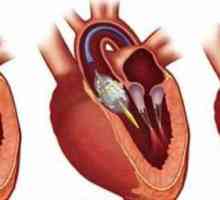 Supapă de inimă: intervenție chirurgicală pentru înlocuire și boli posibile