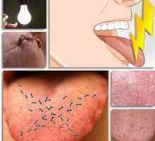 Vârful limbii: cauze, caracteristici de tratament și recomandări