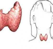 Glanda tiroidă a crescut: simptome. Primele simptome ale bolii tiroidiene
