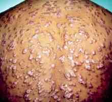 Sifilisul: un simptom al bolii și al tratamentului