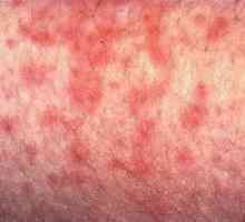 Simptomele infecției cu citomegalovirus și diagnosticul acesteia