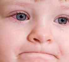 Simptomele și tratamentul conjunctivitei la copii