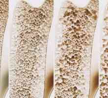 Simptomele și tratamentul osteoporozei. Efectele și prevenirea osteoporozei la femei și bărbați