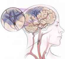 Simptome și tratament pentru accident vascular cerebral ischemic