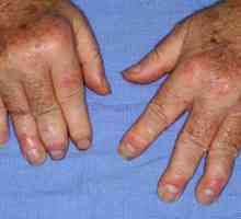 Simptomele și tratamentul artritei psoriazice