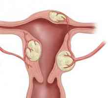 Simptomele și semnele de fibrom uterin: cum se recunoaște boala