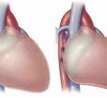 Simptomele pericarditei cardiace și tratamentul. Pericardita uscată: Simptome