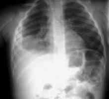 Simptomele pneumoniei la sugari. Tratamentul, consecințele bolii