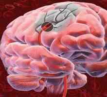 Simptomele de accident vascular cerebral, precum și o descriere a primului ajutor medical.