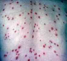 Simptomele sifilisului și prevenirea