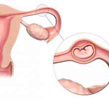 Simptomele sarcinii ectopice, cauzele și consecințele acesteia