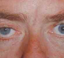 Sindromul Argyla-Robertson: cauze, semne, tratament