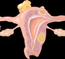 Sindromul epuizării ovariene: cauze, simptome, diagnostic și tratament