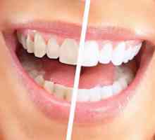 Sistem de albire a dinților Global White: comentarii. Global White: avantajele și dezavantajele