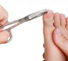Staple Fraser - tratament nedureros al toenailului ingrosat