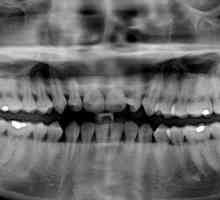 Câte canale în dintele maxilarului superior și inferior?