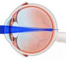 Astigmatism miopic complex al ambilor ochi la copii: tratament