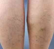 Rețeaua vasculară pe picioare: cum să scapi de, cauzele și caracteristicile tratamentului