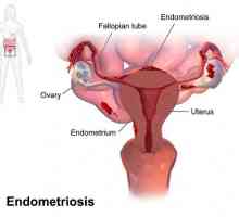 Spirala "Mirena" la o endometrioză: răspunsuri