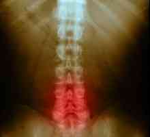 Spondilartroza coloanei vertebrale lombare: cauze, simptome și tratamentul bolii