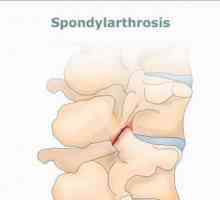Spondiloartroza: cauze și tratament. Spondilartroza coloanei vertebrale lombosacrale