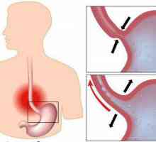 Stenoza esofagiană: cauze, simptome, tratament
