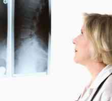 Scleroza subchondrală a coloanei vertebrale - ce este și care sunt cauzele?