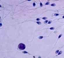 Teratozoospermia - ce este? Principalele cauze ale infertilității masculine