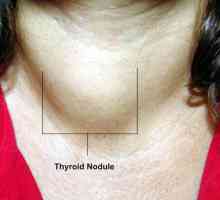 Adenomul tiroidian toxic: cauze, simptome, tratament