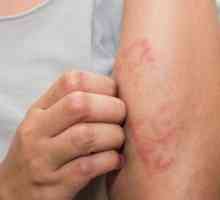 Dermatită alergică toxică: cauze, simptome, tratament