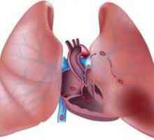 Trombi în plămâni. Tromboembolismul arterei pulmonare: cauze, simptome, efecte, tratament